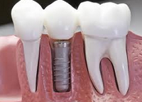 Имплантация зубов