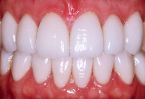 Виниры для зубов