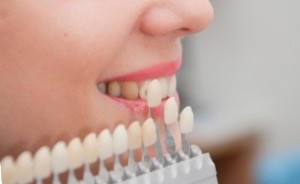 Подборка цвета винира