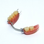 Бюгельные протезы зубов — особенности, фото