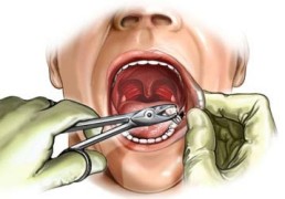 Удаление зуба