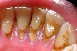 Коричневый зубной налет