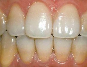 Мягкий зубной налет