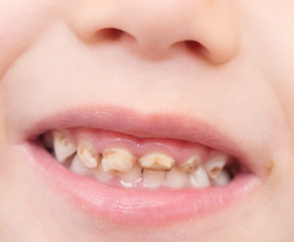 Кариес у детей