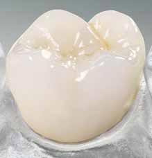 Керамическая коронка