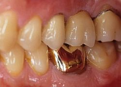 Металлическая коронка