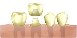 Коронка на зуб