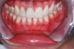 Лечение пародонтита - фото