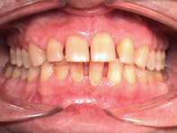 Пародонтит до лечения