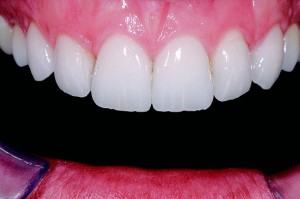 Реставрация передних зубов