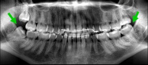 Рентген зубов мудрости