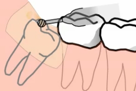 Удаление зуба мудрости на нижней челюсти