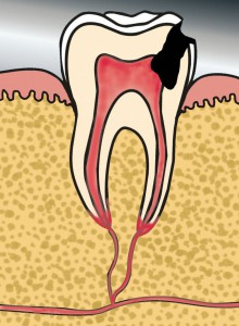 Пульпит - воспаление пульпы
