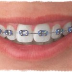 Виды брекетов, их преимущества и недостатки