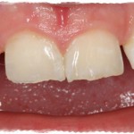 Бруксизм у взрослых, причина и лечение