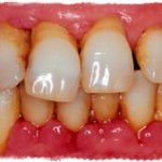 Пародонтоз – болезнь зубов и всего организма