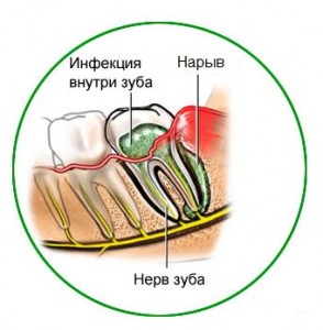Гнойное воспаление десны - лечение