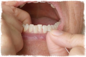 Гигиена при кровотечении десен