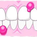 Гной из десны около зуба, лечение