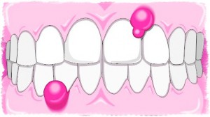 Почему гноятся десны?