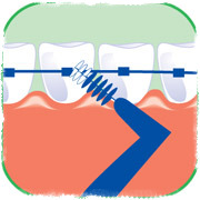 Правильная чистка брекетов