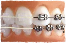 Виды брекет систем