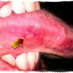 На языке прыщик болит, что делать