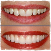 Пример керамических виниров