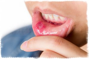Лечение стоматита во рту