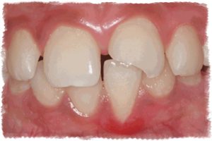 Изготовление виниров при травме зуба