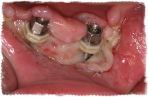 Воспаление имплантата после операции Воспаление имплантата после операции