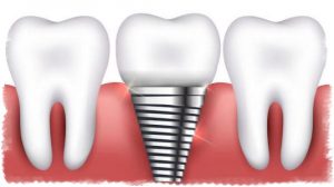 Пример имплантации зуба