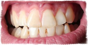 Наддесневой зубной камень