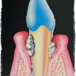 Поддесневой зубной камень