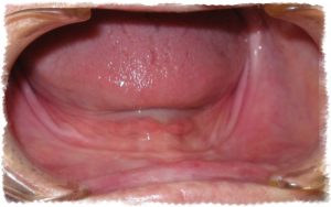 Полная адентия