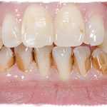 Зубной камень, как избавиться в домашних условиях