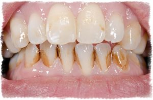 Зубной камень пример